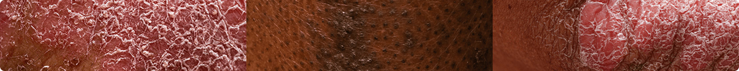 Three side-by-side close-ups of skin texture. One close-up of skin with Hidradenitis suppurativa. One close-up of skin with PSO. One close-up of skin with PsA