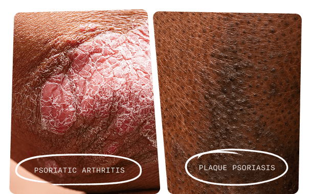Close-up of a bent elbow with PsA and close-up of a shin with PSO