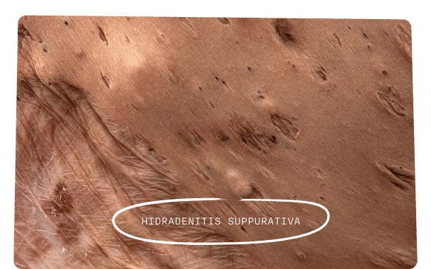 Close-up of skin on the back showing Hidradenitis suppurativa