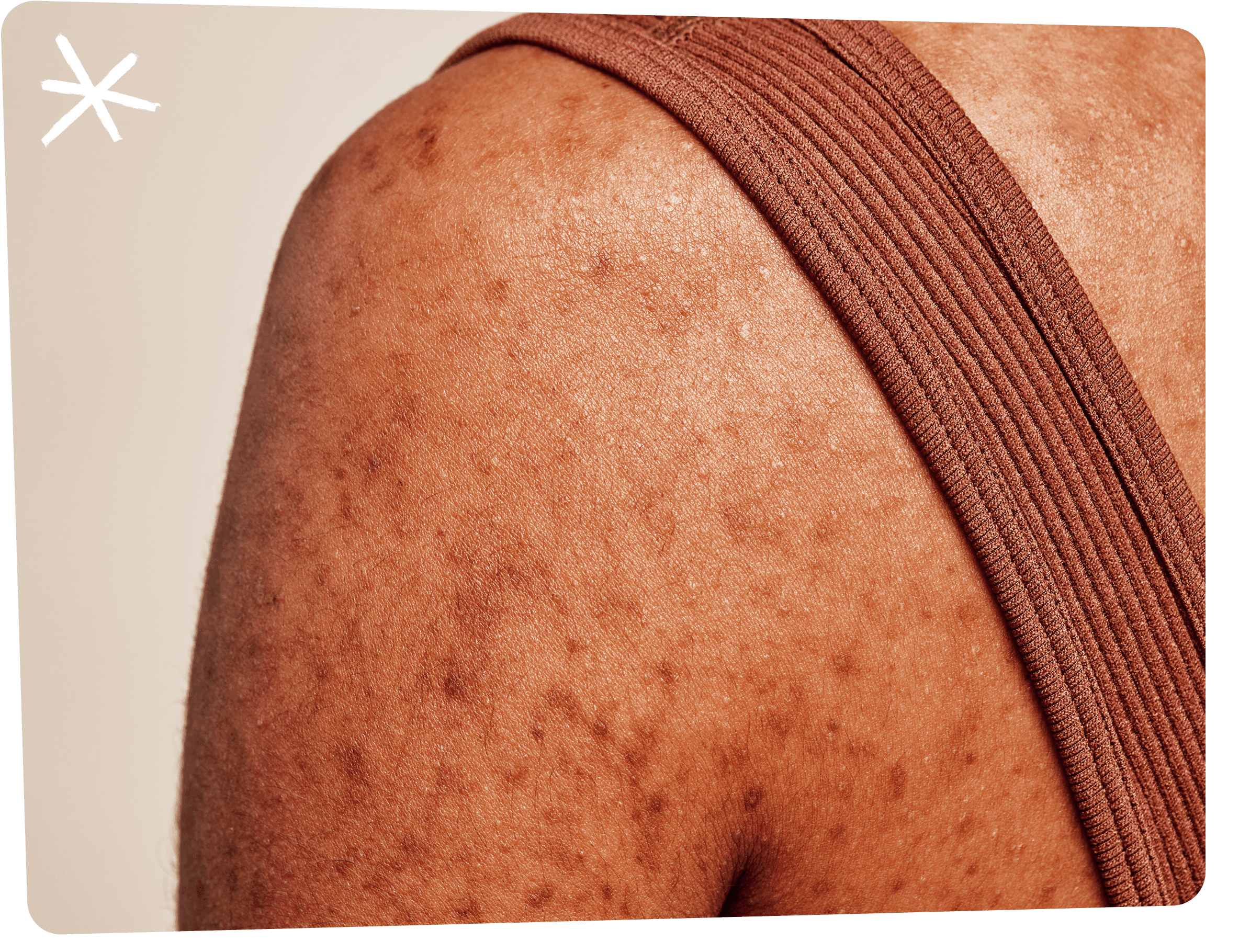 Close-up of a person's bare shoulder and upper arm with visible skin discoloration, a rust-colored strap across the shoulder
